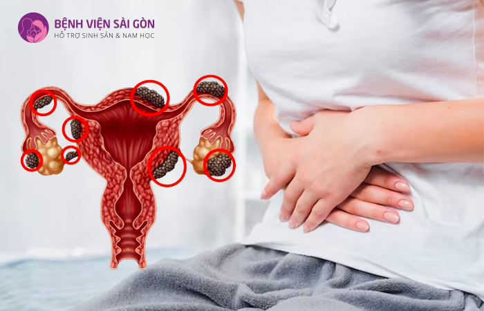 Lạc nội mạc tử cung là 1 trong những nguyên gây dẫn đến u nang buồng trứng 